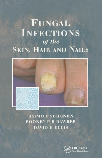 Book cover of: Fungal Infections of the Skin and Nails. By: Raimo E. Suhonen