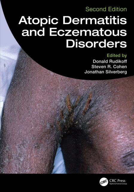 Book cover of: Atopic Dermatitis and Eczematous Disorders
