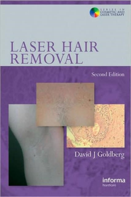 Laser Hair Removal