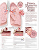 Book cover of: Chronic Obstructive Pulmonary Disease Anatomical Chart