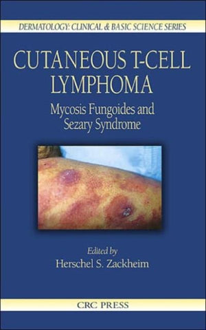 Cutaneous T-Cell Lymphoma