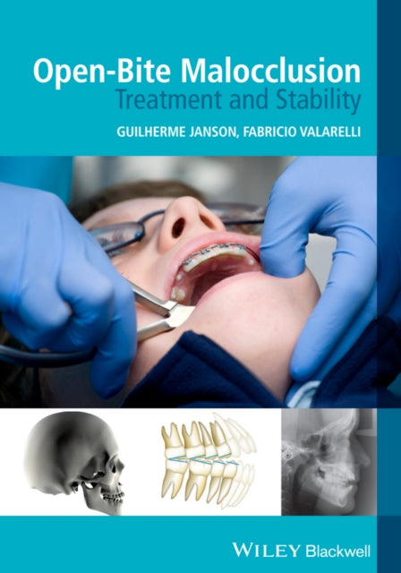 Book cover of: Open-Bite Malocclusion. By: Guilherme Janson