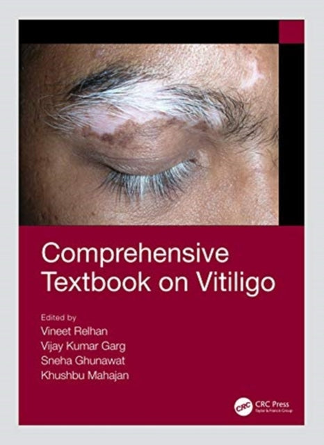Book cover of: Comprehensive Textbook on Vitiligo. By: Vijay Kumar Garg