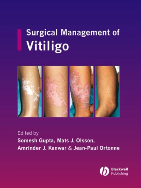 Book cover of: Surgical Management of Vitiligo