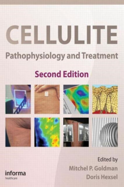 Book cover of: Cellulite. By: Mitchel P. Goldman