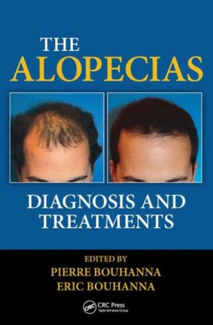 Book cover of: Alopecias. By: Pierre Bouhanna