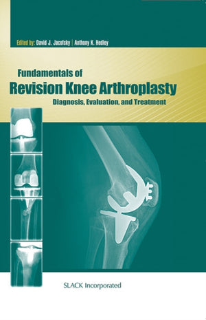 Fundamentals of Revision Knee Arthroplasty