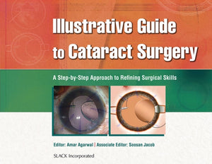 Illustrative Guide to Cataract Surgery