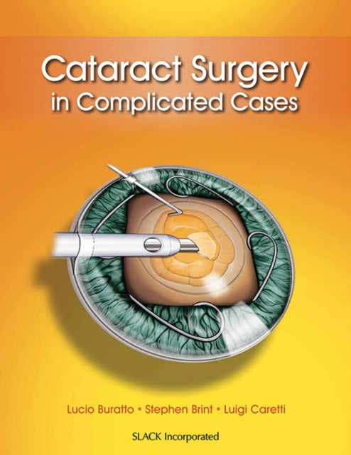 Book cover of: Cataract Surgery in Complicated Cases