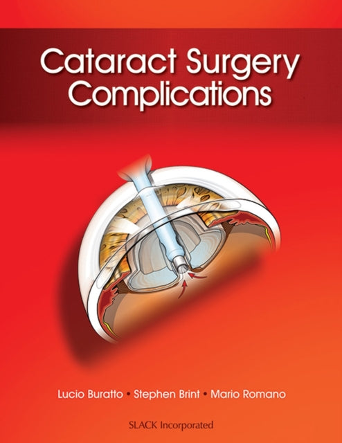 Book cover of: Cataract Surgery Complications. By: Lucio Buratto MD
