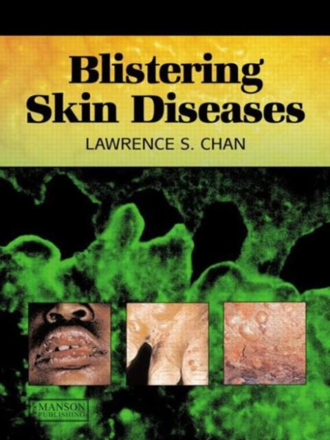 Book cover of: Blistering Skin Diseases