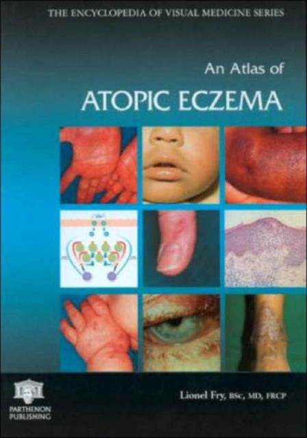 Book cover of: Atlas of Atopic Eczema