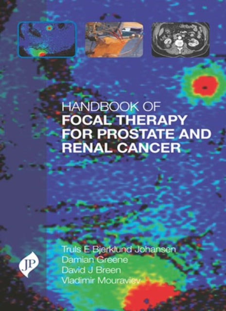 Book cover of: Handbook of Focal Therapy for Prostate and Renal Cancer. By: Truls Bjerklund Johansen