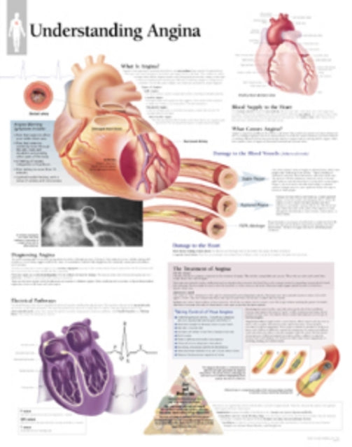 Book cover of: Understanding Angina Laminated Poster. By: Scientific Publishing