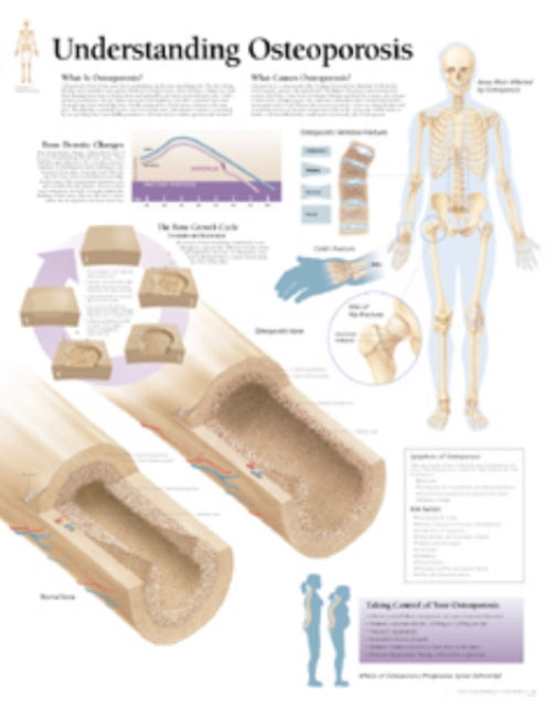 Book cover of: Understanding Osteoporosis Laminated Poster. By: Scientific Publishing