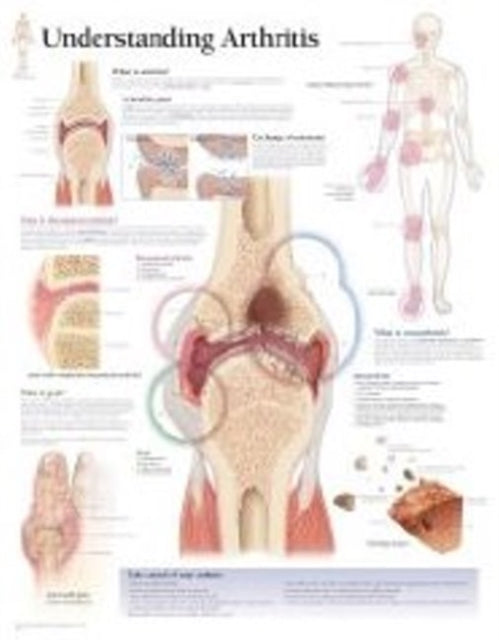 Book cover of: Understanding Arthritis Paper Poster. By: Scientific Publishing