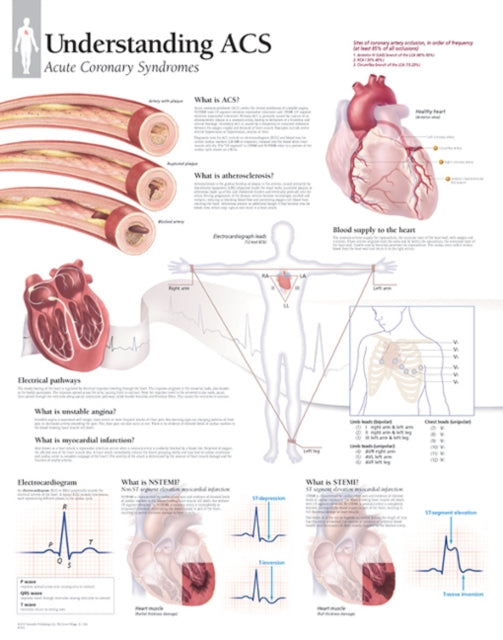Book cover of: Understanding ACS (Acute Coronary Syndrome) Laminated Poster