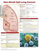 Book cover of: Non-Small Cell Lung Cancer, Chart Laminated