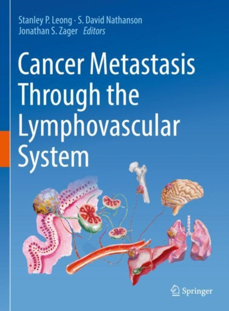 Book cover of: Cancer Metastasis Through the Lymphovascular System. By: Stanley P. Leong