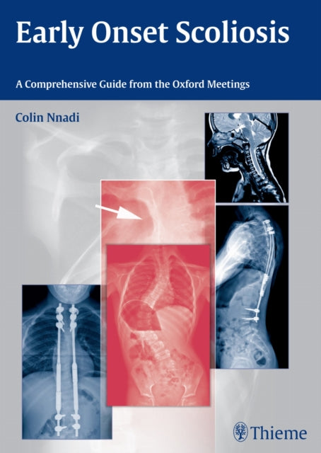 Book cover of: Early Onset Scoliosis. By: Colin Nnadi