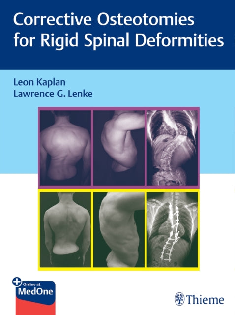 Book cover of: Corrective Osteotomies for Rigid Spinal Deformities. By: Leon Kaplan