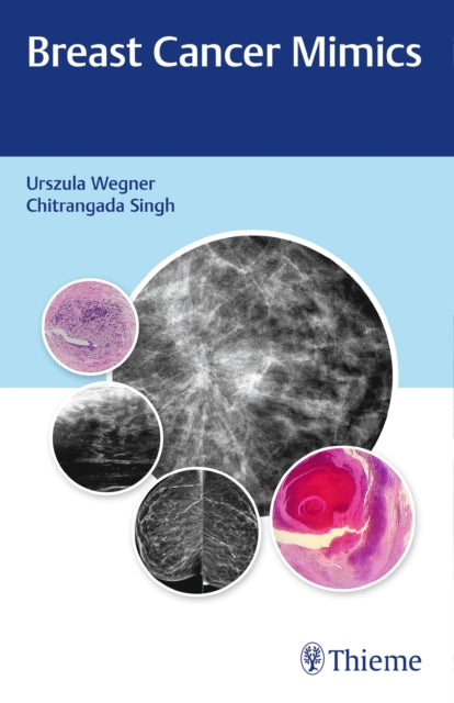 Book cover of: Breast Cancer Mimics. By: Wegner